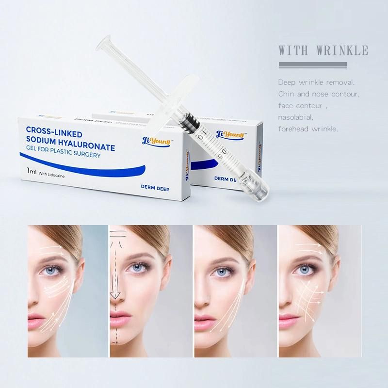 Hyaluronic Acid Injection Dermal Filler with Lidocaine