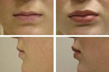 2ml Facial Injections Cross-Linked Hyaluronic Acid Dermal Filler for Lip Enhancement