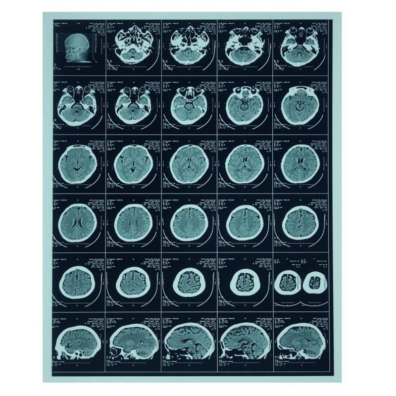 8X10 Medical X Ray Film Blue