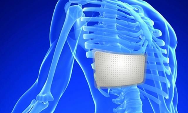 Orthopaedic Rib Fixed Splint Chest Rib Splint