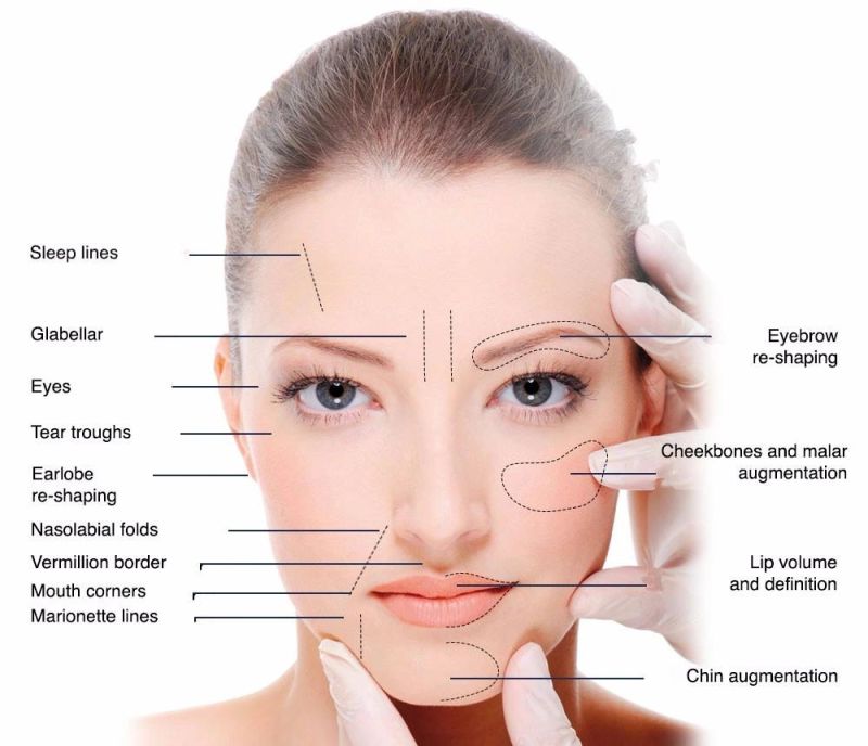 Nose Bridge Cheek Chin Jawline Temples Injectable Dermal Filler Hyaluronic Acid Dermal Filler