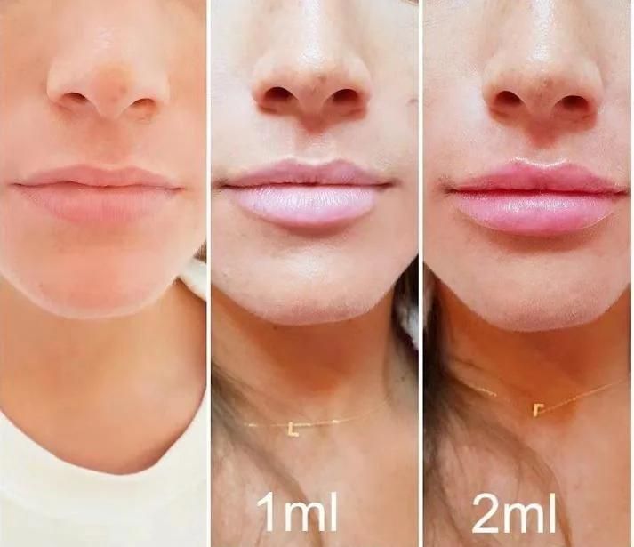 2ml Facial Injections Cross-Linked Hyaluronic Acid Dermal Filler for Lip Enhancement