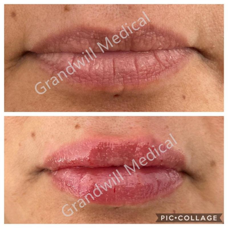 Lip Facial Contouring Cross Linked Hyaluronic Acid Dermal Filler