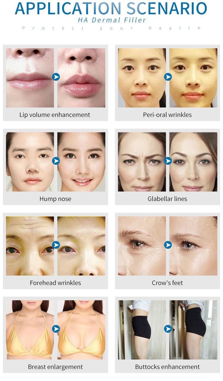 Cosmetic Surgery for Face Wrinkles Around Mouth From Korea Hyaluronic Acid Dermal Filler