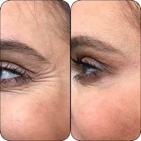 Neuramis Rejeunesse Dermalax Yvoire Revolax Hyafilia Sculptra Filler