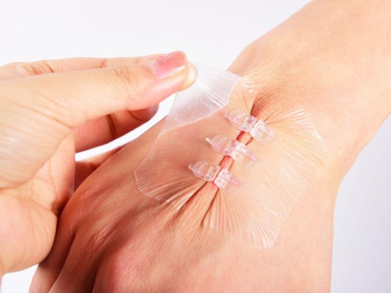 Medical Skin Adhesive Wound Closure Device