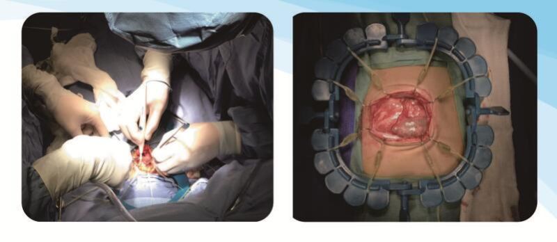 Disposable Surgical Retractor Ring