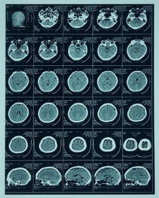 Thermal Printing X-ray Film for Medical