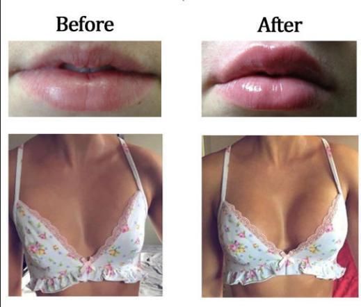 2021 Best Products Hyafilia Ha Lip Dermal Filler Injections