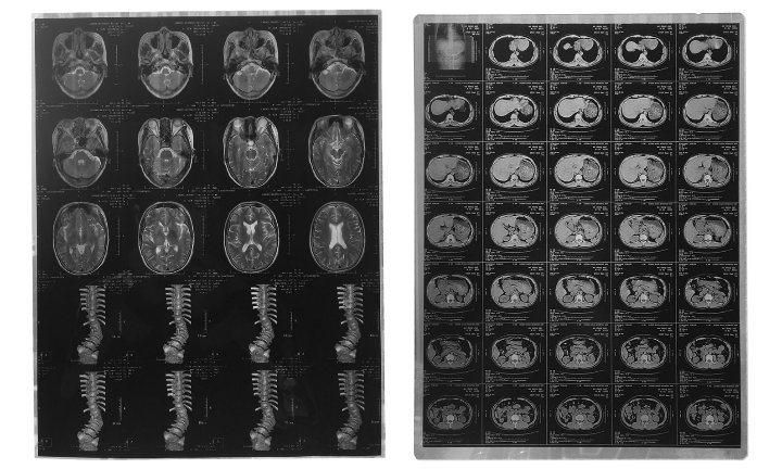 Hospital Blue Base Inkjet Medical X-ray Film X Ray Blue Film