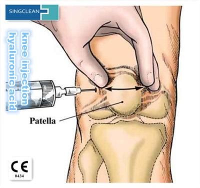 Ce Hyaluronic Acid Knee Injections Intra-Articular Injections Price