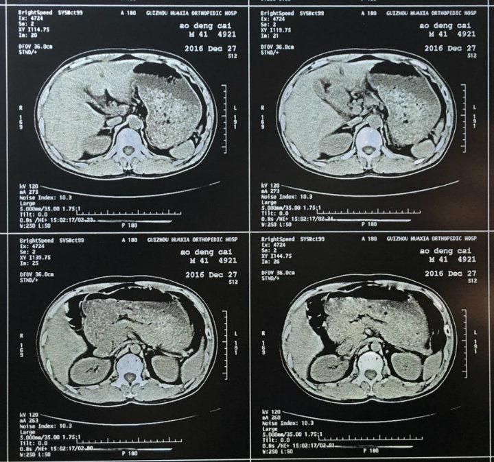 Laser Image Medical X-ray Film for FUJI Xerox Drypix 3500 Printer