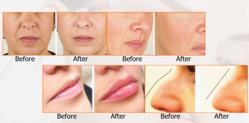 CE Sungel Cosmetic Lip Injection Hyaluronic Acid Dermal Filler for Plastic Surgery