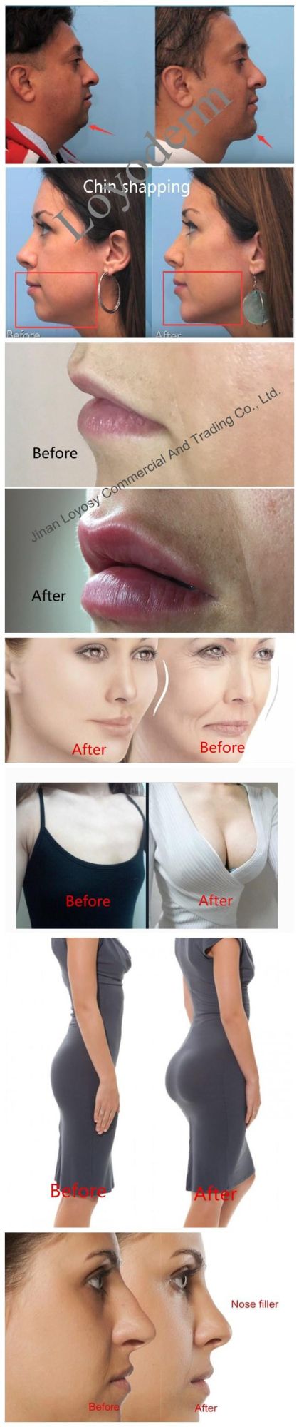 Hyaluronic Acid Injection Dermal Filler with Lidocaine