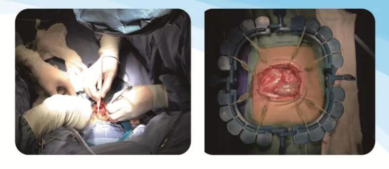 Disposable Lone Star Surgical Medical Retractor Ring