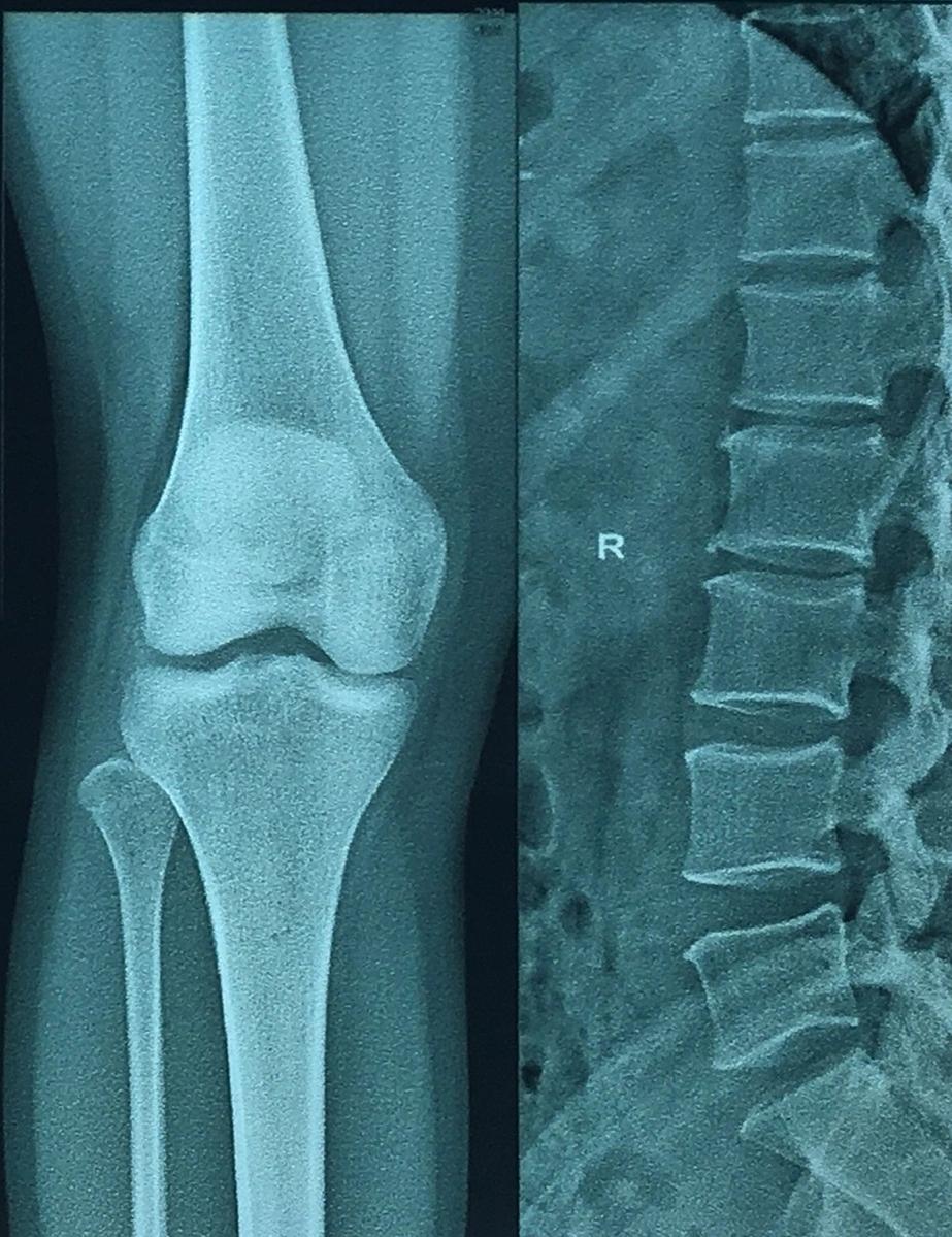 Radiographic Medical X-ray Film Imaging