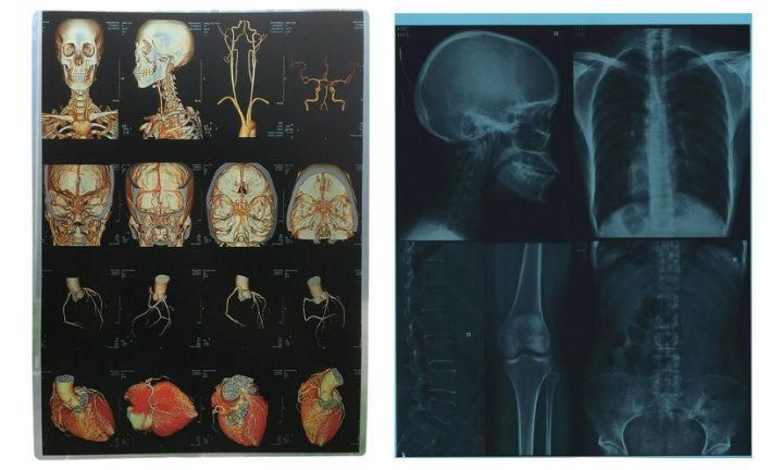 Ultrasound Digital Printing Blue and White Inkjet Film