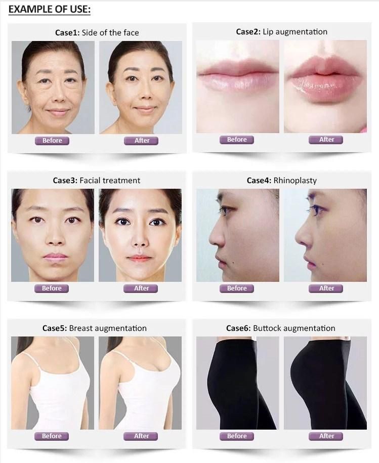 Korea Elravie Bonetta Neuramis Revolax Juvederms Yvoire Dermalax Bellast Hyaluronic Acid Derm Filler Injection