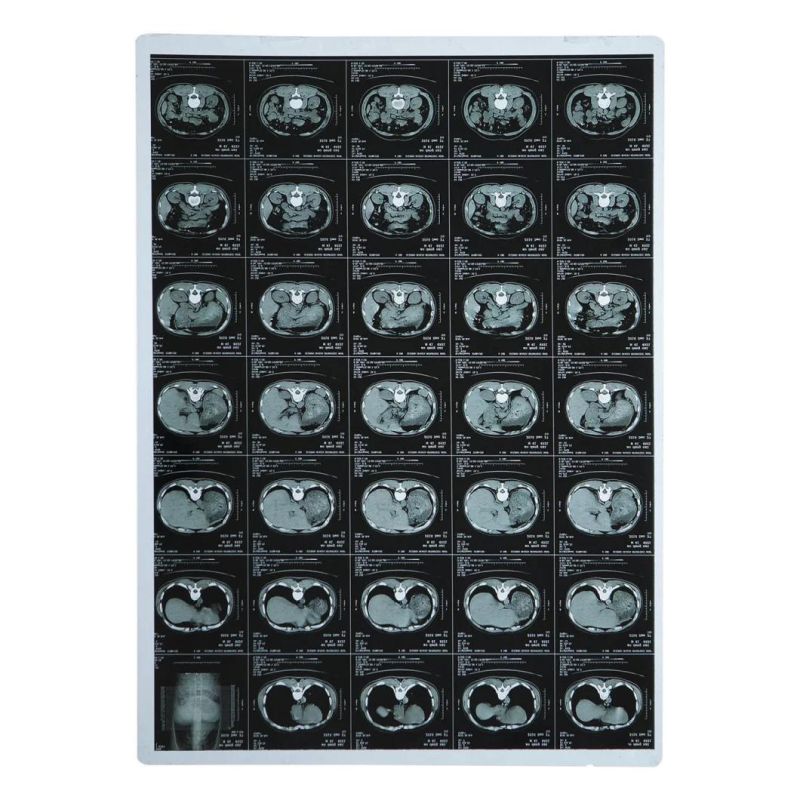 Radiology Department X-ray Blue Thermal Dry Films