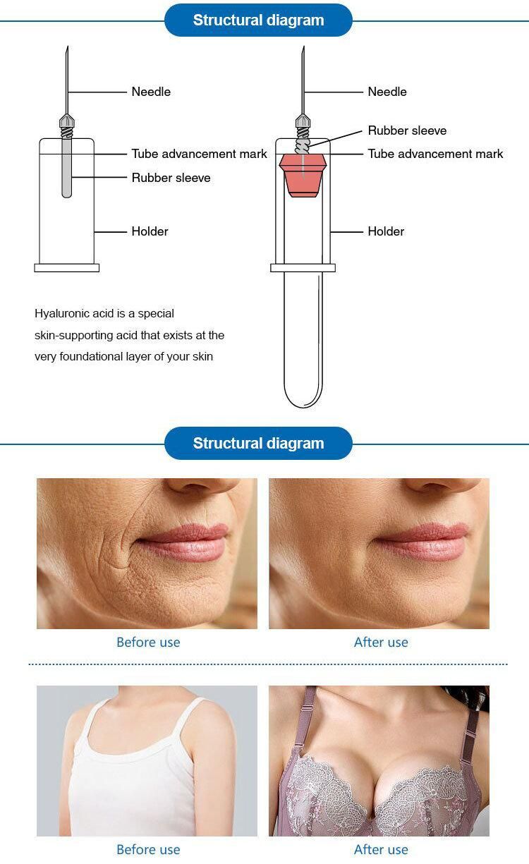  Beauty Personal Care Cross Linked Hyaluronic Acid Injection Dermal Filler Butt/ Buttock Injection