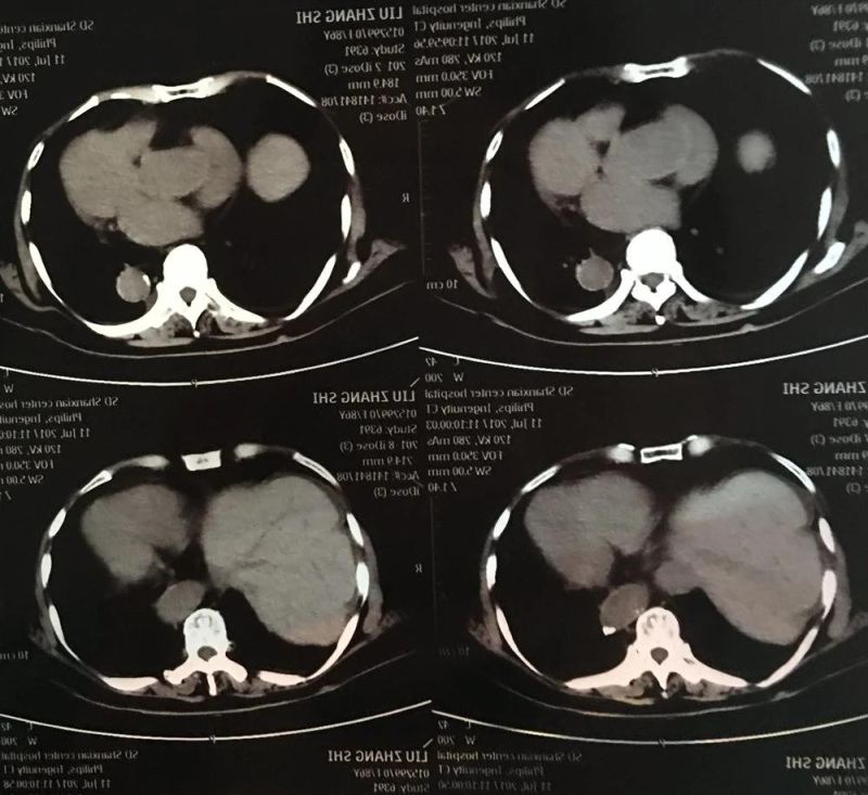 14X17 Inkjet Medical Dry Films for Hospital Ultrasound Dept.