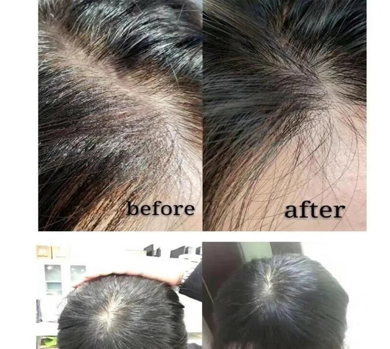 Best Way to Increase Grow Natural Black Hair Loss Fall Promote Fast Hairline Growth Treatment Women