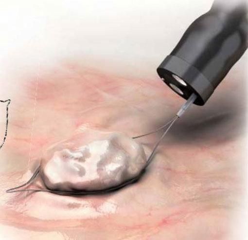 Gastroenterology Polypectomy Cold Snare for Polyps Less Than 10mm