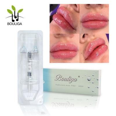 Hyaluronic Acid Dermal Filler Anti Aging Lip Filler