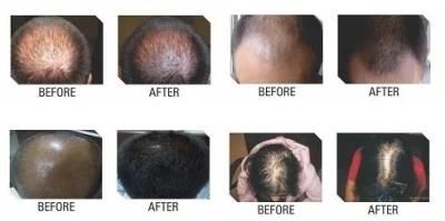 Innoaesthetics Hair Loss Control for Man to Growth Hair Innoaesthetics Hair Loss Control