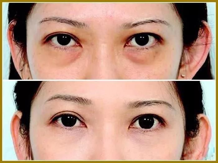 Anti Wrinkle Facial Dermal Fillers for Removing Eyes Circle Tear Grooves