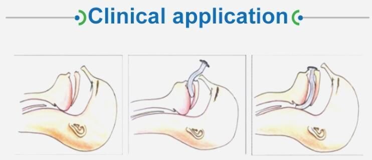 ISO and CE Certificate Medical Disposable Products Guedel Airways