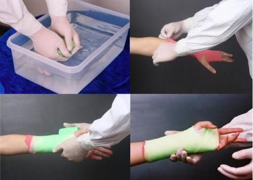 Best Selling Medical Consumable Orthopaedic Fiberglass Casting Tape & Splint