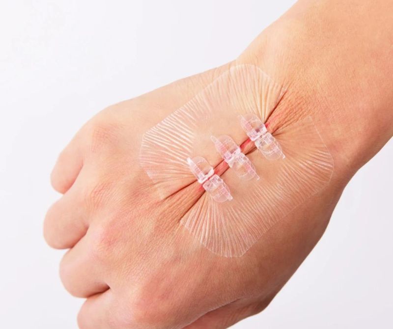 CE Approved Medical Adhesive Wound Closure Device