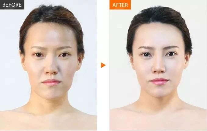 Ocean Star Injectable Hyaluronic Acid Dermal Filler for Nose