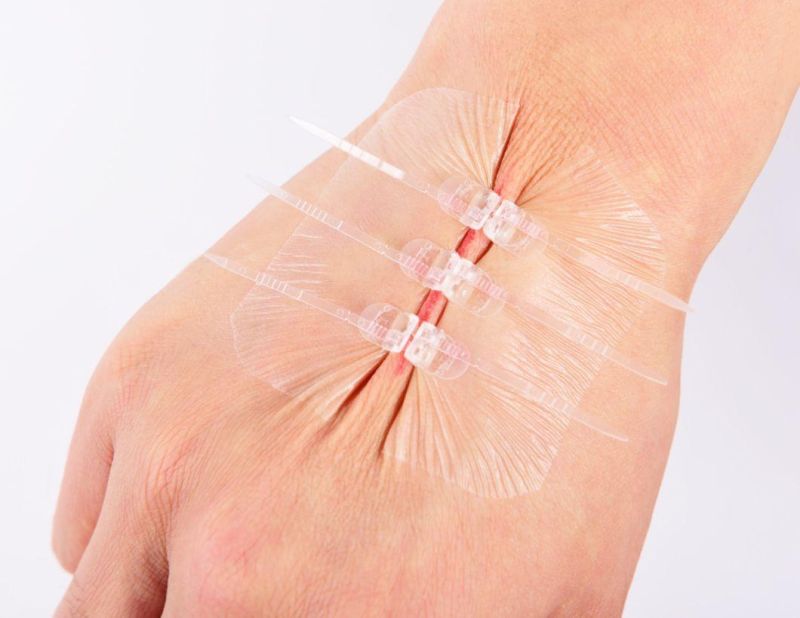 New Design! Medical Skin Adhesive Wound Closure Device Plaster