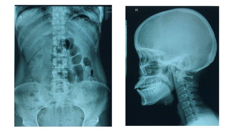 Hospital Use Radio Graphic Medical X-ray Film Imaging