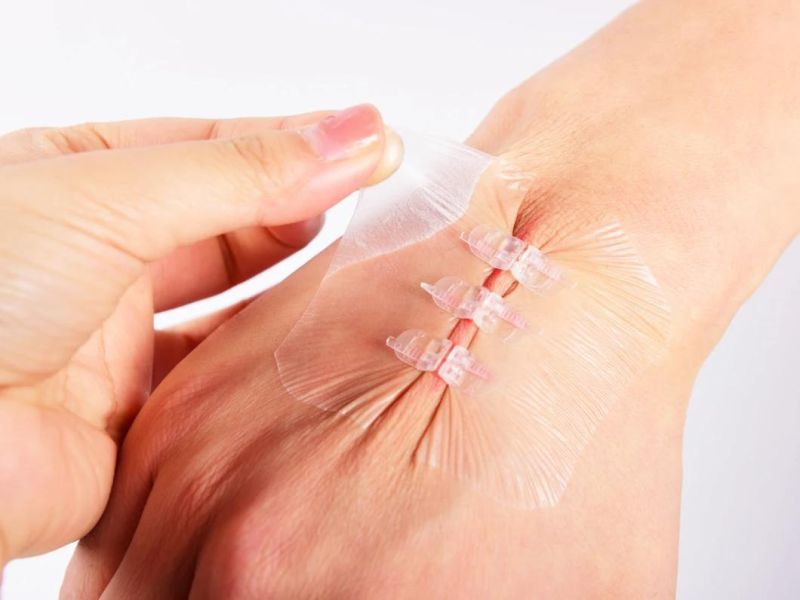 CE Approved Medical Adhesive Wound Closure Device