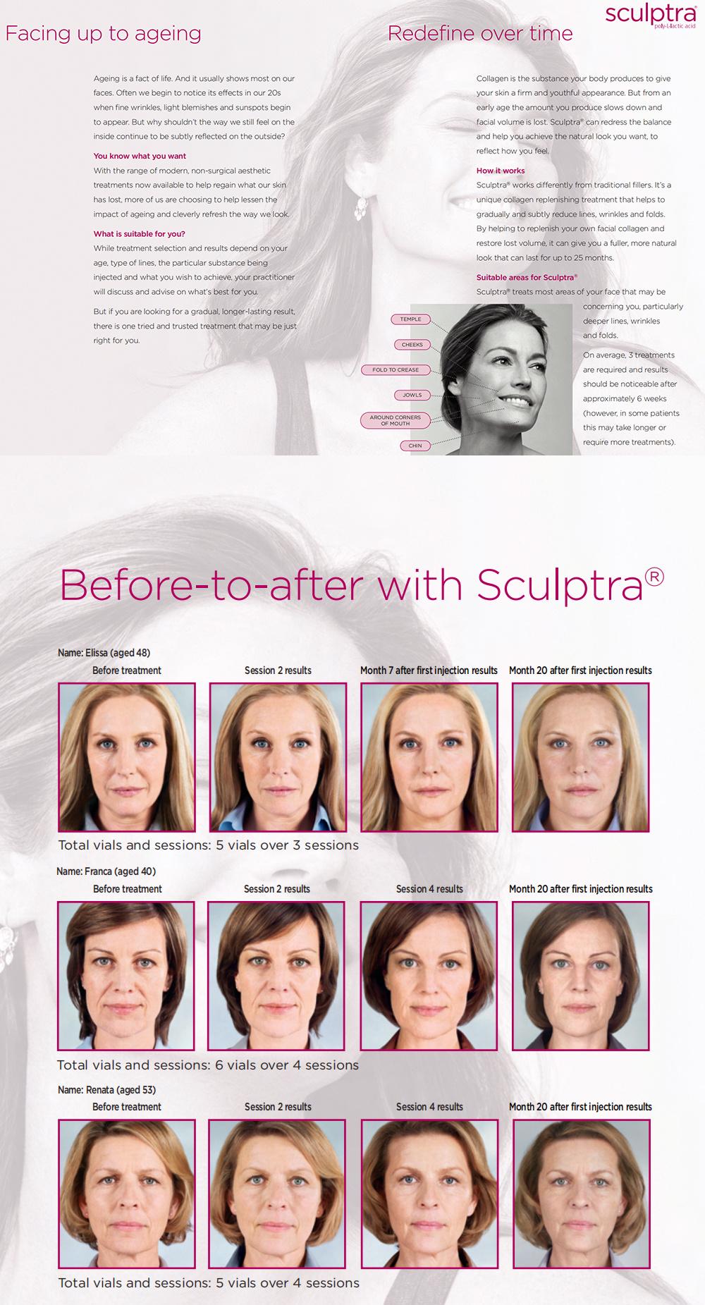 Sculptr Plla Filler Hot Selling Hip Dips Brazillian Butt Lift