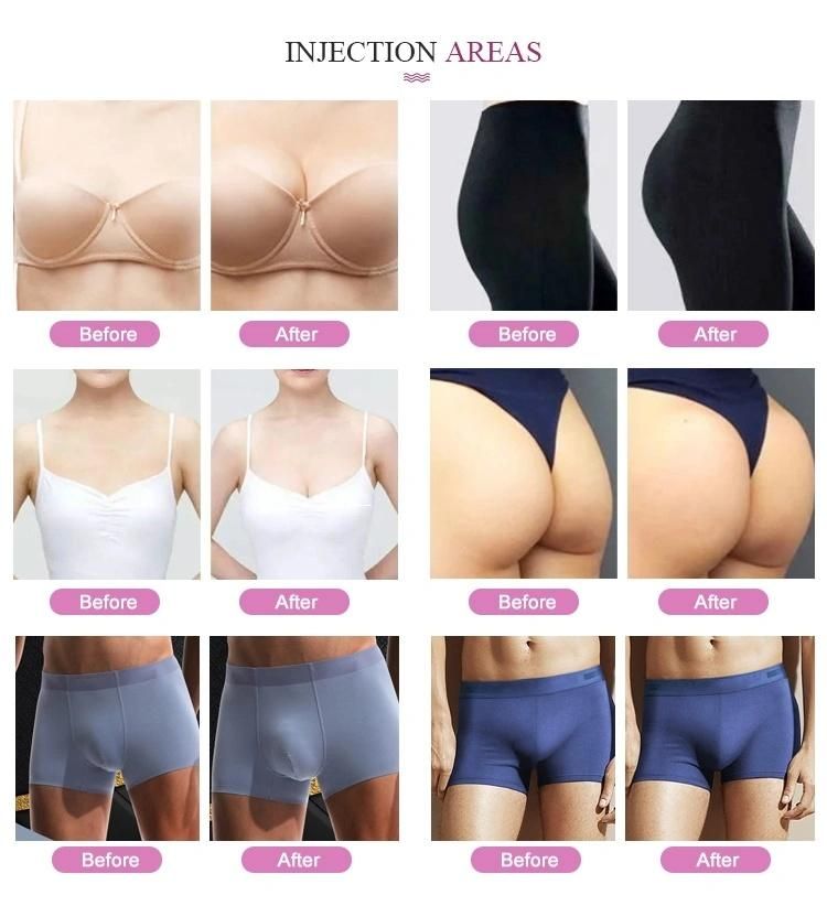 Heremefill Best-Selling Hyaluronic Acid Dermal Fillers Are Used for Breast Enlargement and Butt Enhancement