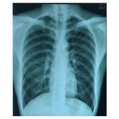 A3 and 13*17 Inch Medical X-ray Blue Film