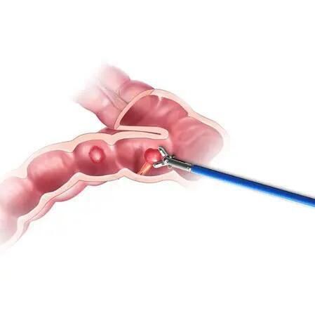 Surgical Endoscopic Disposable Alligator Forceps