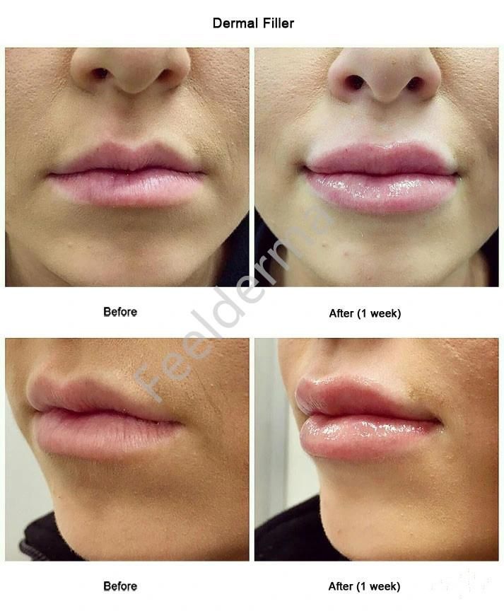 Juvaderm Ultra 3 Ultra 4 Voluma Hyaluronic Acid Dermal Filler