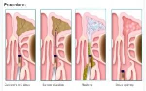 Sinuplasty Balloon Catheter System for Ent Feild Medical Device