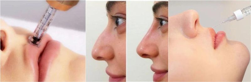 China Wholesale Mono-Phasic 24mg Ha Gel Lidocaine Injection Dermal Filler Hyaluronic Acid for Filling Facial Wrinkles