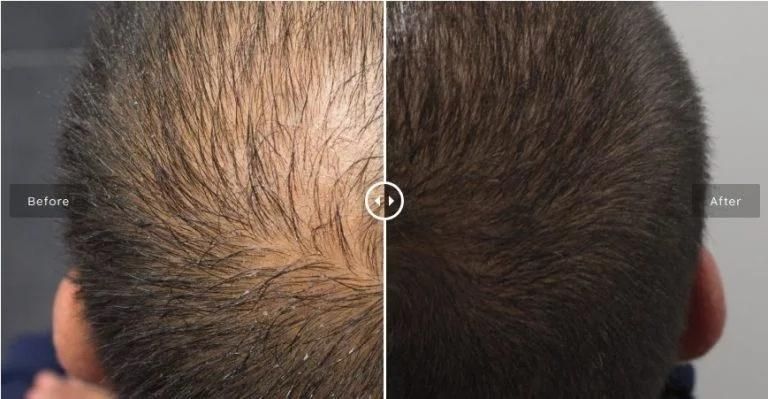 Innoaesthetics Hair Loss Control for Man to Growth Hair Innoaesthetics Hair Loss Control