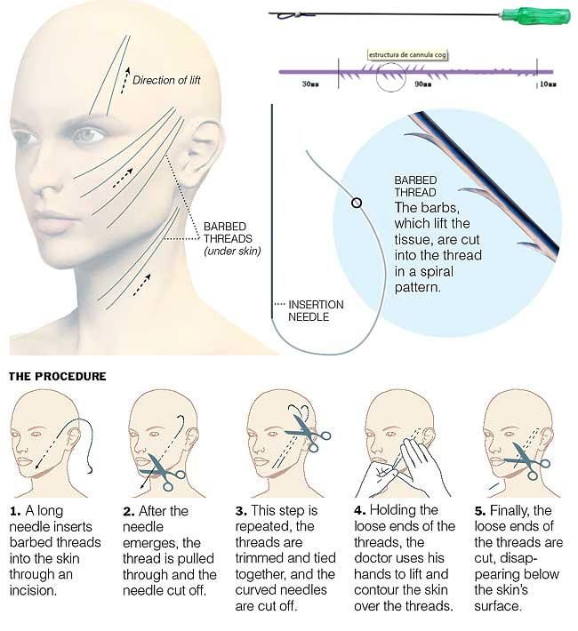 Cosmetic Mono Pdo Threads for Full Face Lifting Injection Near Me