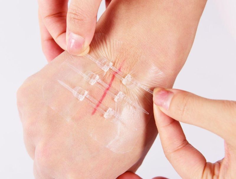 New Design! Medical Skin Adhesive Wound Closure Device Plaster