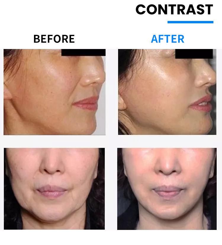 Face Lifting Surgical Suture Collagen Mono Cog Pdo Thread