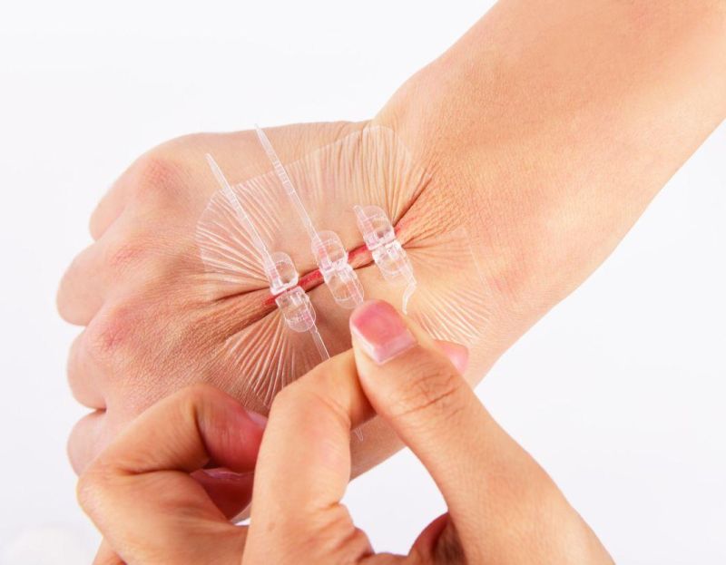 Medical Skin Adhesive Wound Closure Device