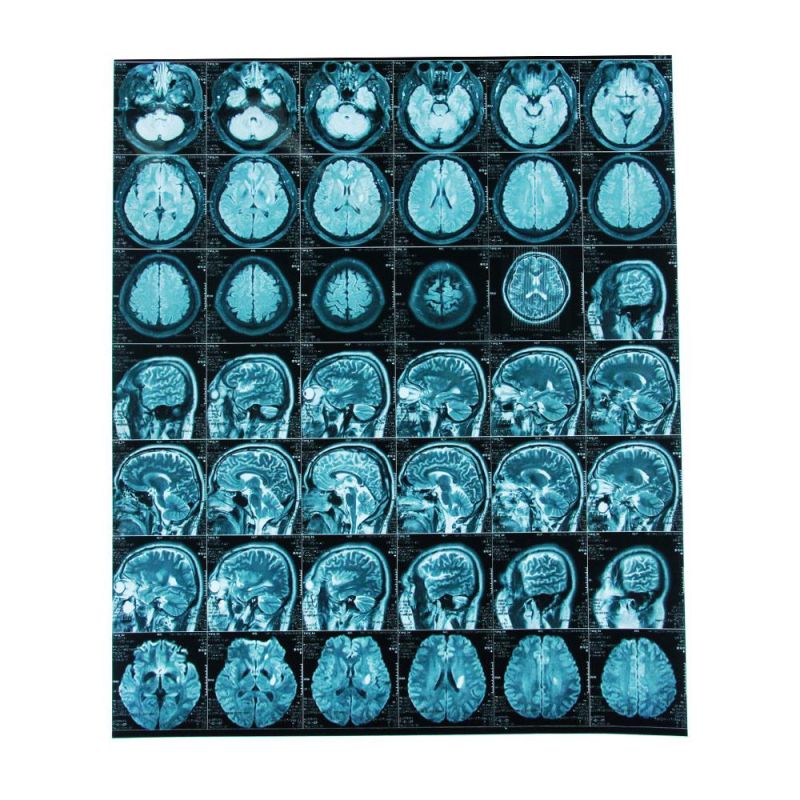 Printing Radiology Universal Medical Thermal Hospital Blue X-ray Film